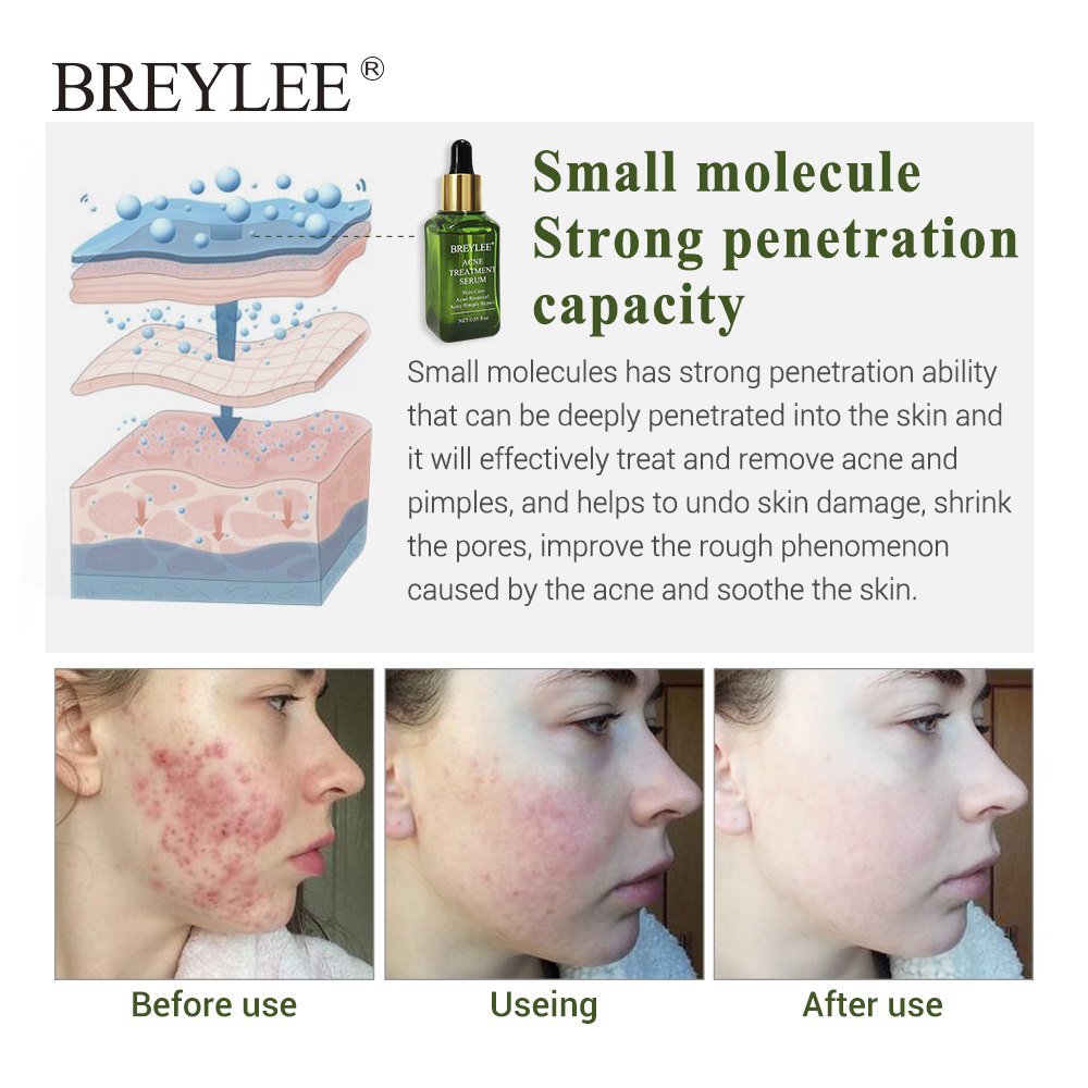 Zaverna Acne Behandelserum - verpakking
