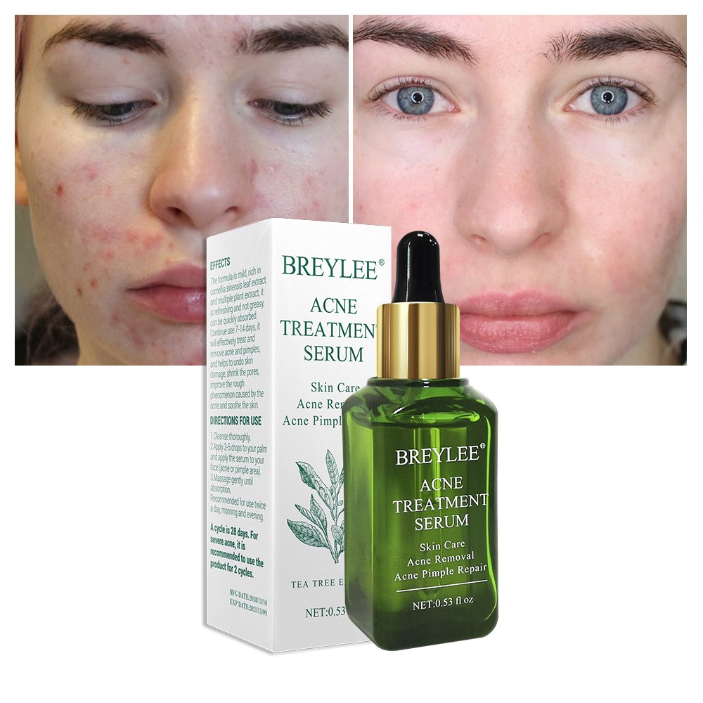Zaverna Acne Behandelserum - toepassing